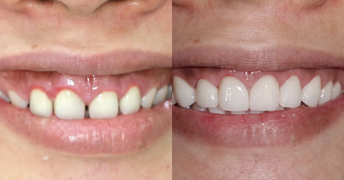 Boc rang su Can Tho Nha khoa APEX