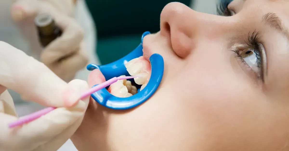 Boi Fluoride Ngua Sau Rang Tai Nha Khoa APEX An Toan Chuyen Nghiep