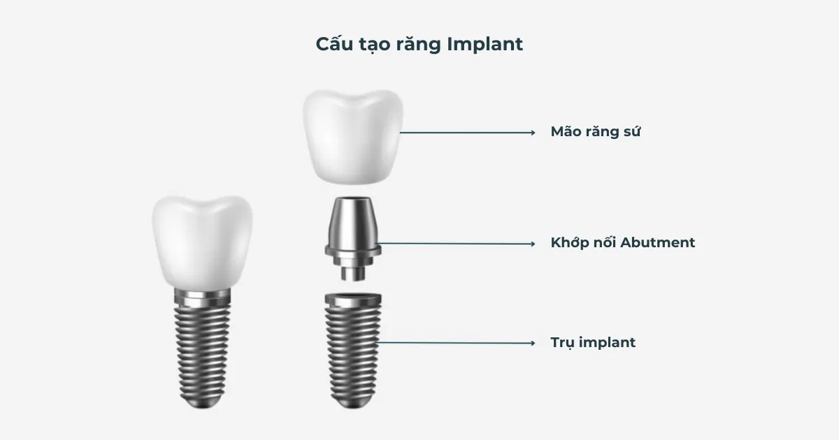 Trồng Răng Implant 1 Cau tao rang Implant