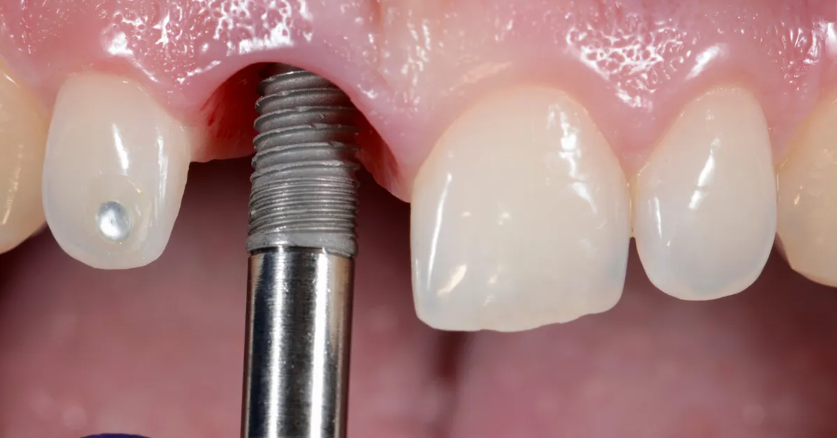 Trồng Răng Implant 2 Cay ghep implant vung R36 3