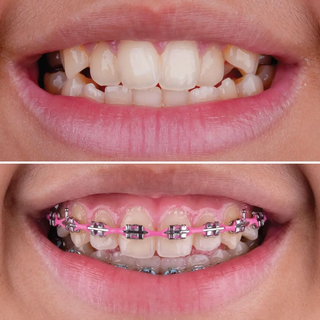 Chinh Hinh Rang Nieng Rang La Gi