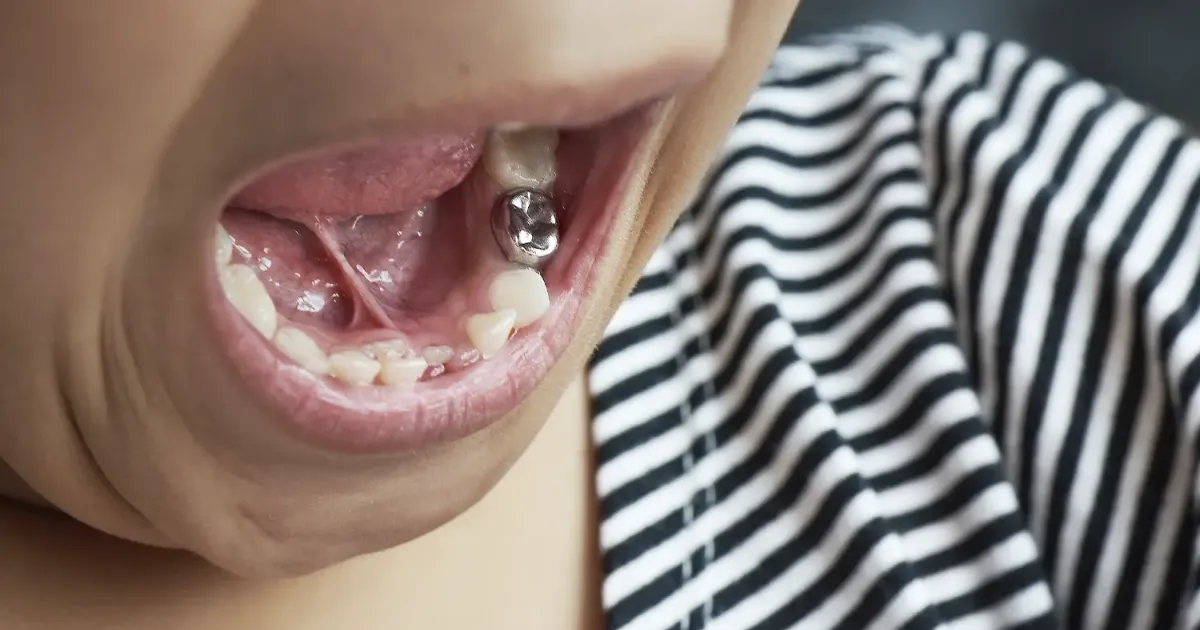 Chup Thep Rang Sua La Gi Giai Phap Nha Khoa Hien Dai Cho Tre