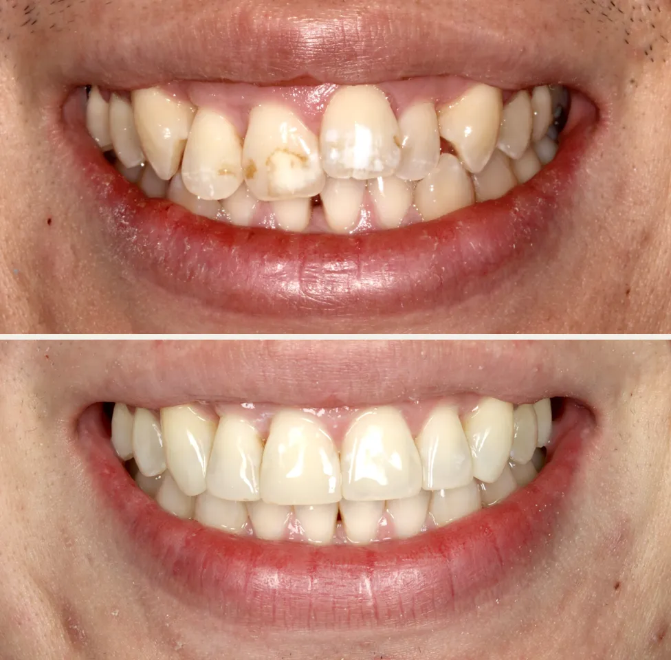 Doi Tuong Phu Hop Voi Nieng Rang Vo Hinh Invisalign