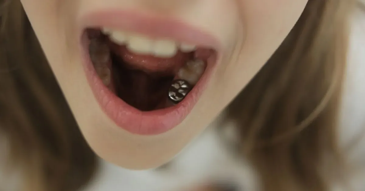 Loi Ich Cua Chup Thep Rang Sua – Dau Tu Cho Nu Cuoi Khoe Manh Cua Be Tai Nha Khoa APEX