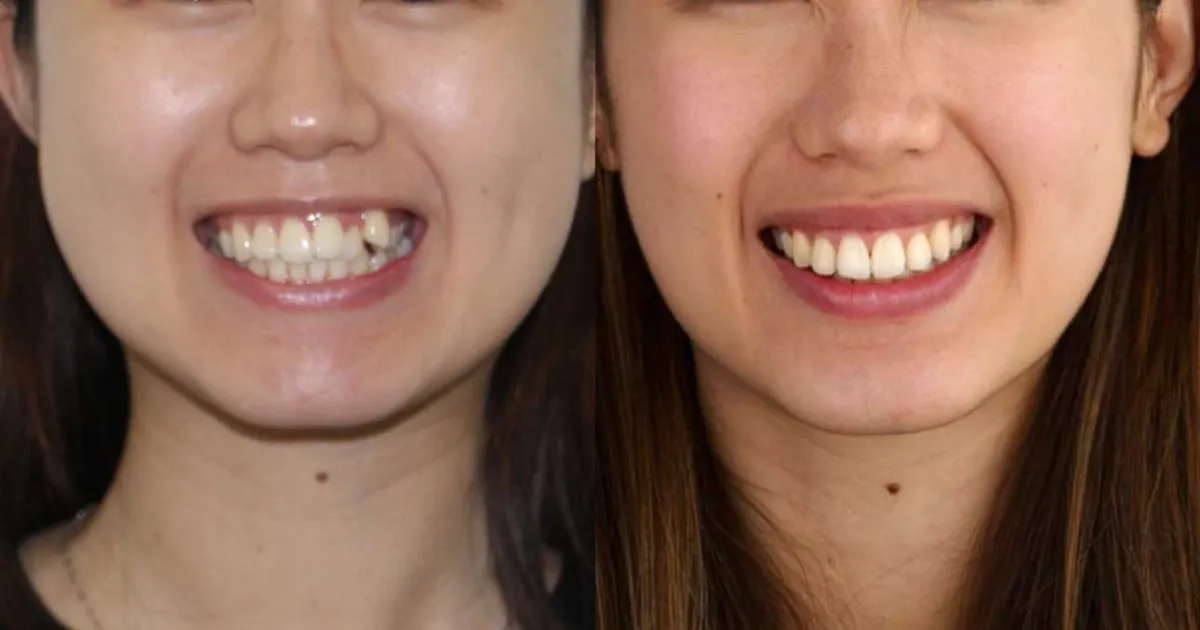 Loi Ich Vuot Troi Cua Chinh Hinh Rang Nieng Rang Mac Cai