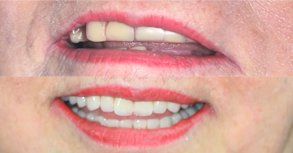 Nha Khoa Apex 6