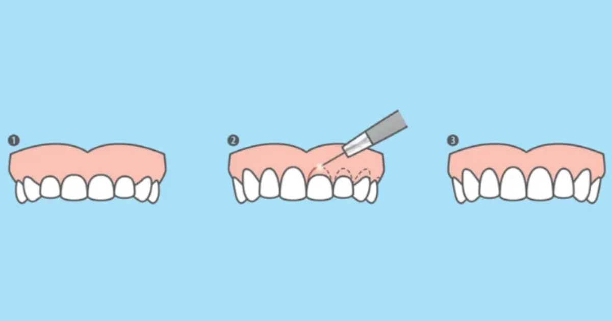 Quy Trinh Dieu Tri Cuoi Ho Loi Chuan Quoc Te Tai Nha Khoa APEX
