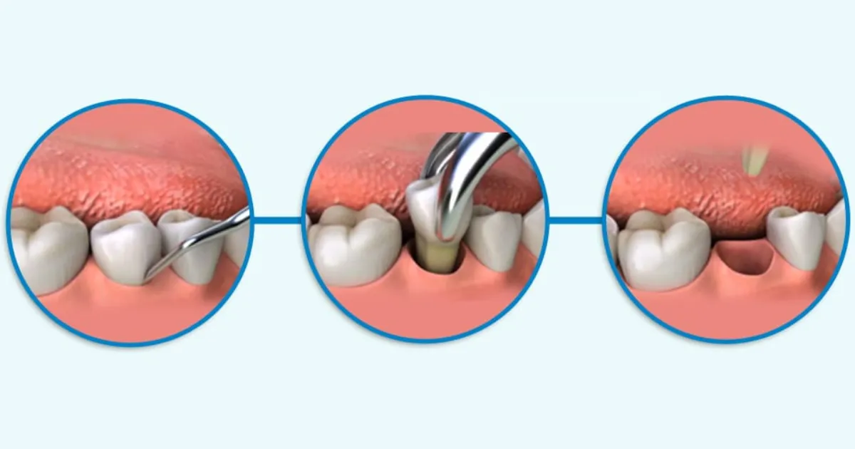 Quy Trinh Nho Rang An Toan Khong Dau Tai Nha Khoa APEX Can Tho