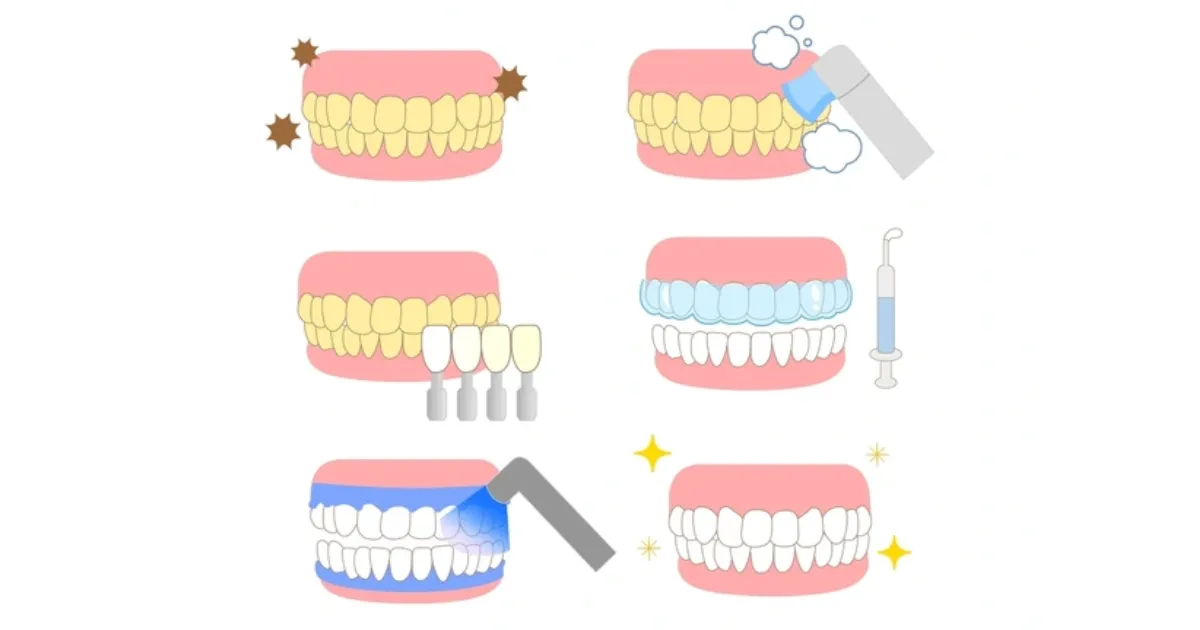 Tẩy trắng răng 3 Quy Trinh Tay Trang Rang An Toan Chuyen Nghiep Tai Nha Khoa APEX