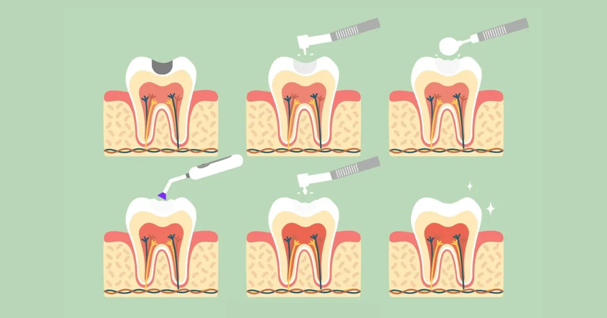Trám răng 3 Quy Trinh Tram Rang Tham My An Toan Khong Dau Tai Nha Khoa APEX