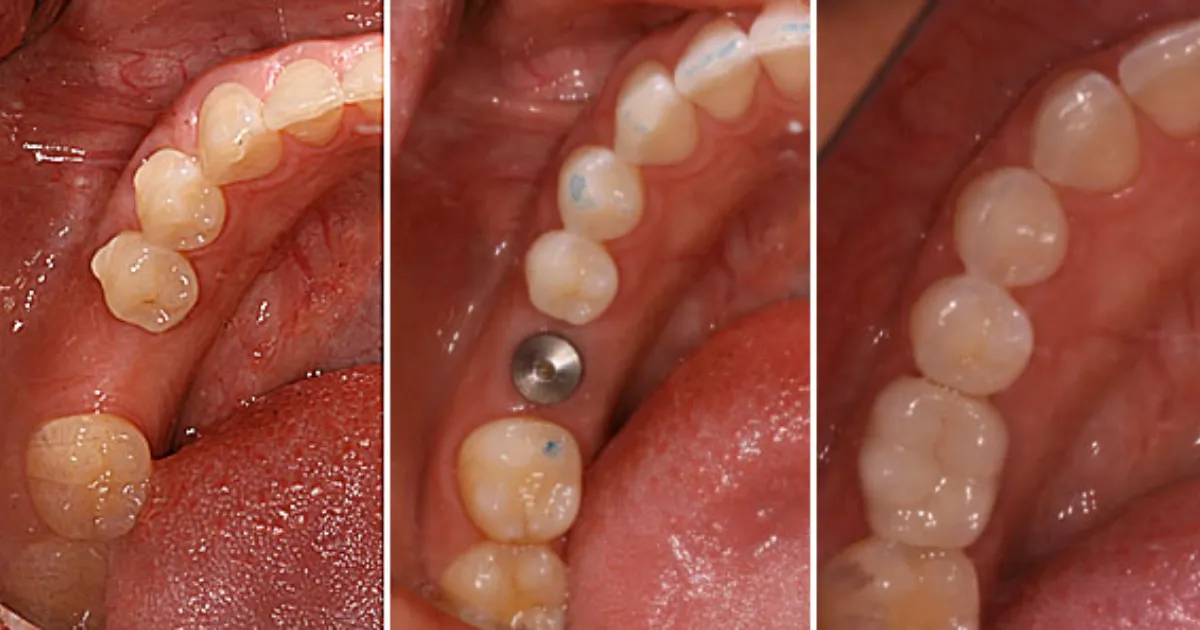 Trồng Răng Implant 3 Quy Trinh Trong Rang Implant Chuan Quoc Te Tai Nha Khoa APEX