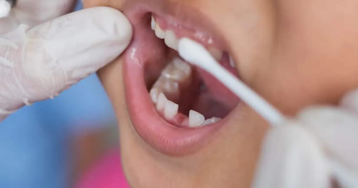 Quy trinh boi Fluoride chuan tai Nha khoa APEX