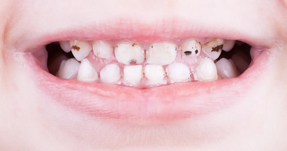 SDF La Gi Giai Phap Moi Ngan Ngua Sau Rang Cho Tre Em