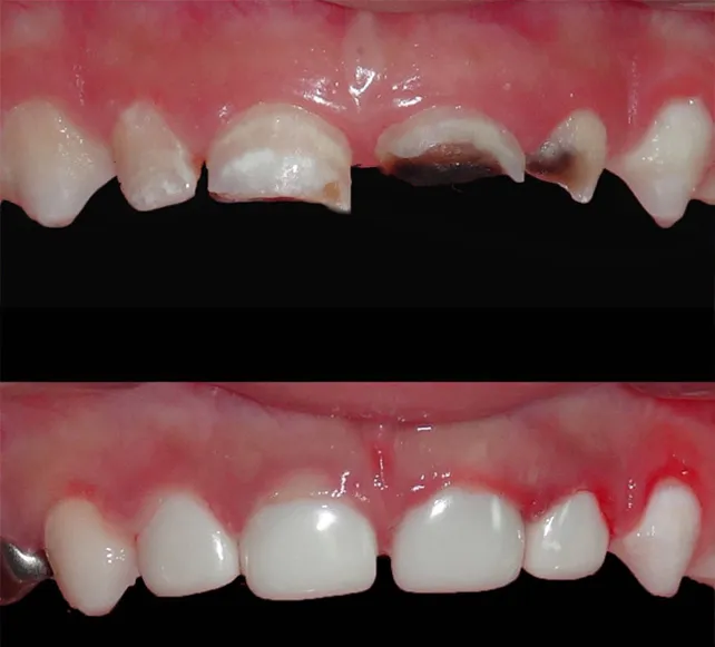 Tai Sao Nen Tram Rang Sua Cho Tre