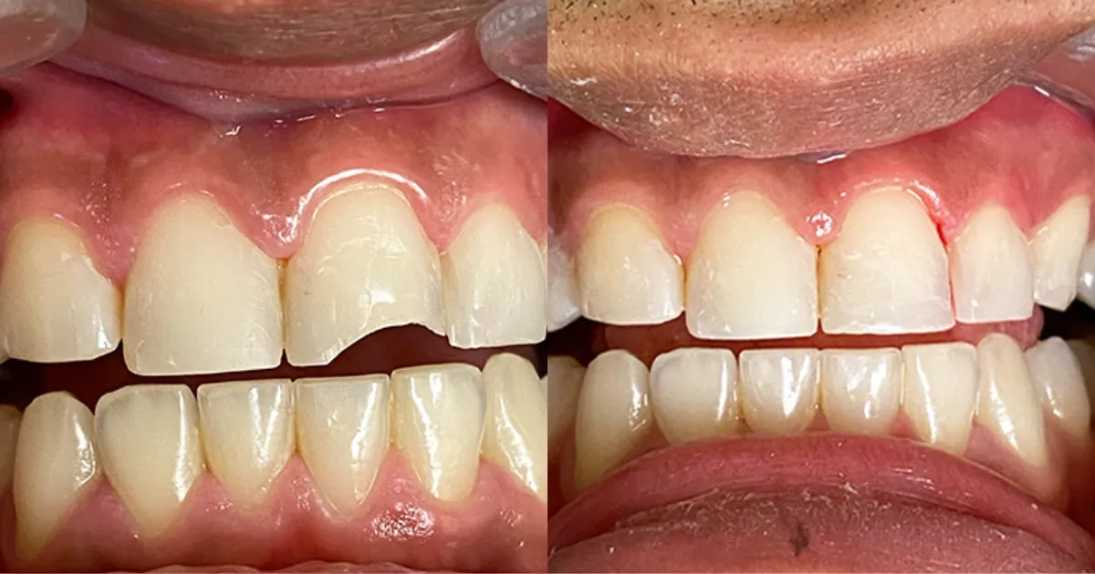 Tram rang Can Tho Nha khoa APEX