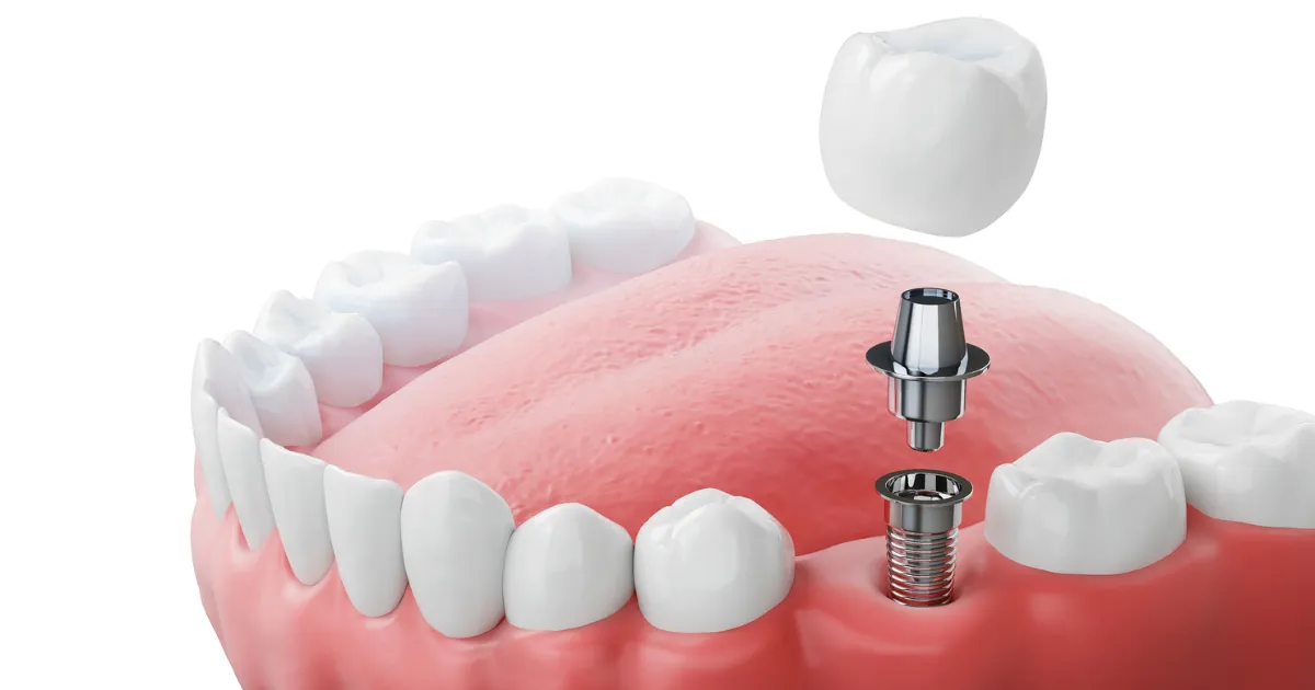 Trồng Răng Implant 4 Truong Hop Nen Va Khong Nen Trong Rang Implant