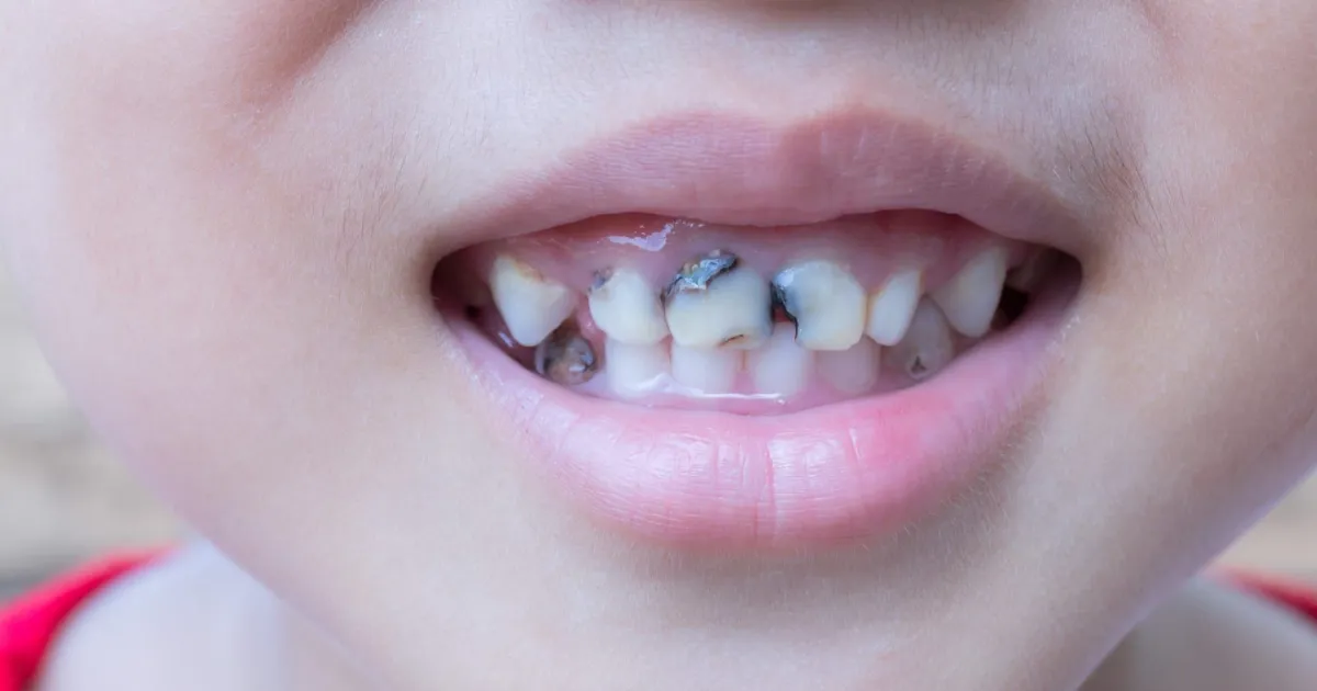 Vi Sao Boi Fluor Lai Quan Trong Cho Rang Sua Cua Tre