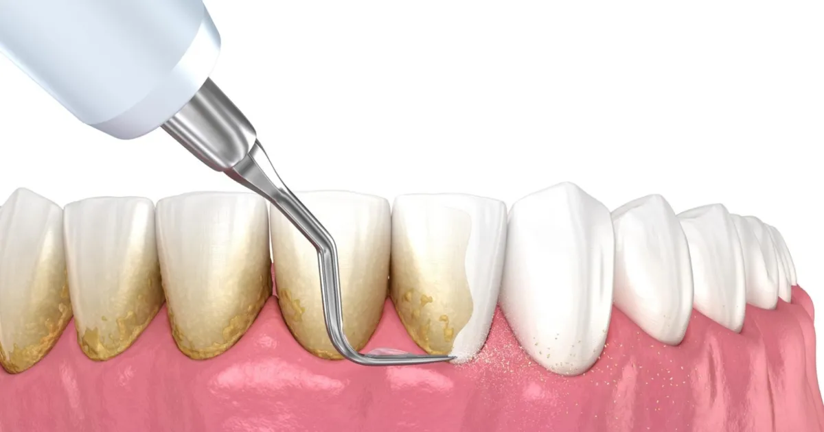 Voi Rang Sat Thu Tham Lang Nguy Hiem Cho Rang Mieng