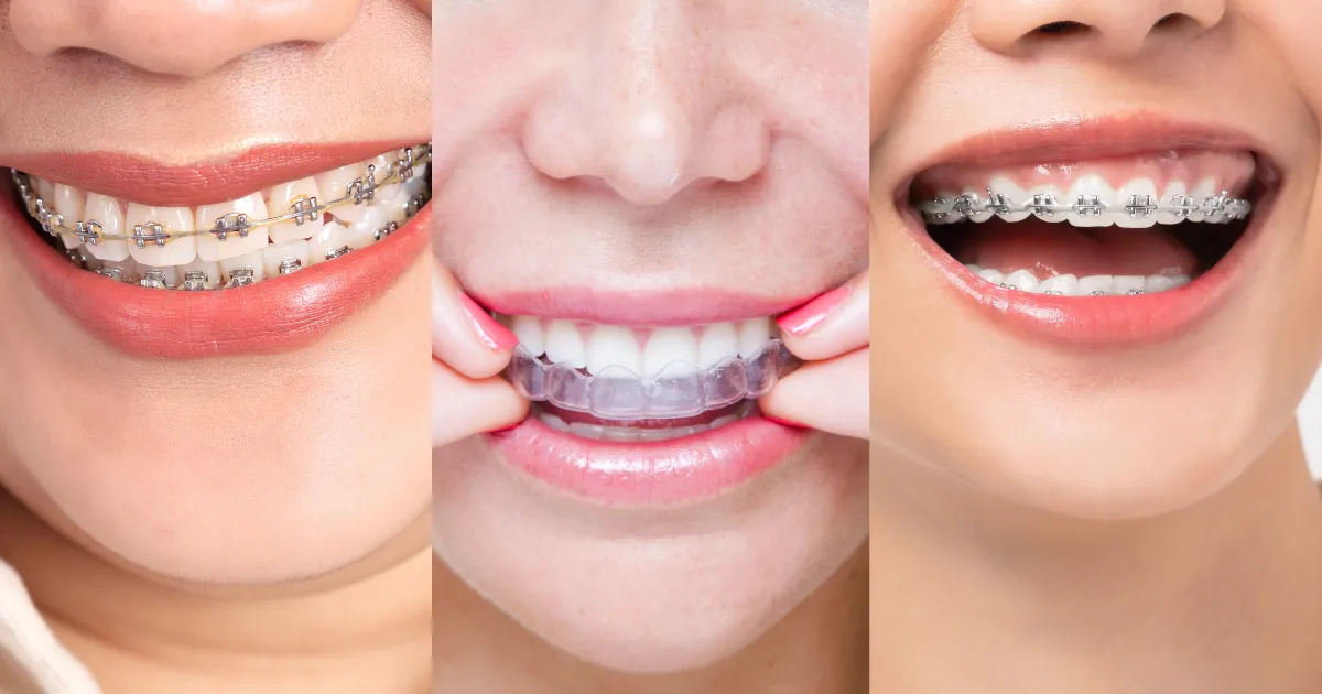 Niềng răng Cần Thơ