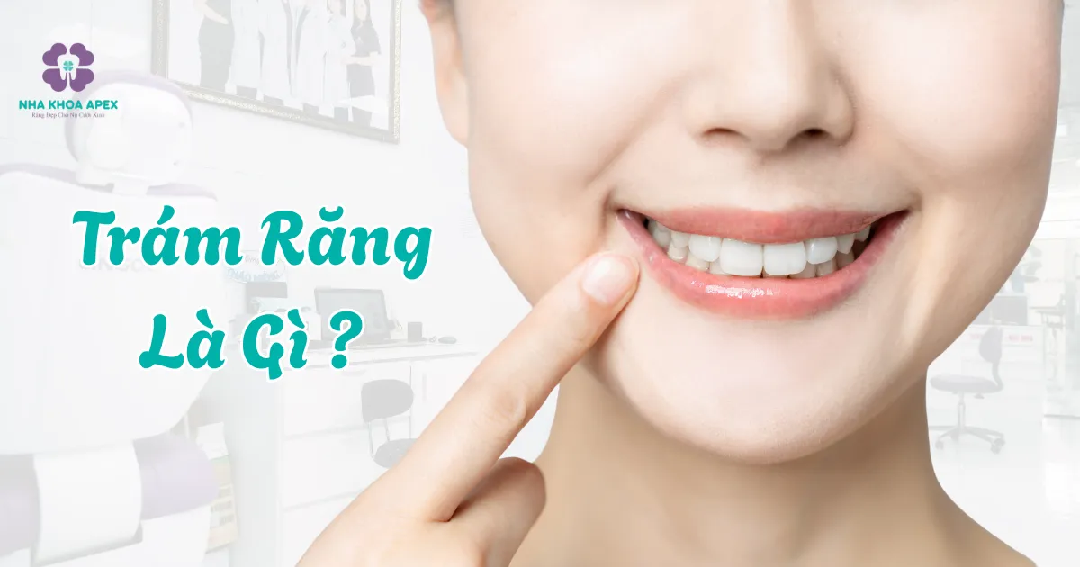 Trám răng Cần Thơ